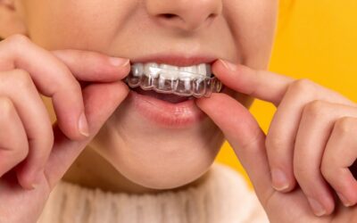 Everything you need to know about Invisalign